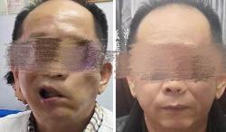 洛阳市嘴歪专科案例