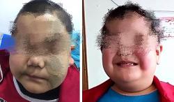 洛阳治疗面瘫案例