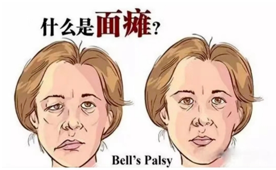春节期间如何预防面瘫：科学防护指南